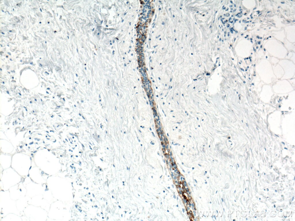 Immunohistochemistry (IHC) staining of human breast hyperplasia tissue using Cytokeratin 5 Monoclonal antibody (66727-1-Ig)