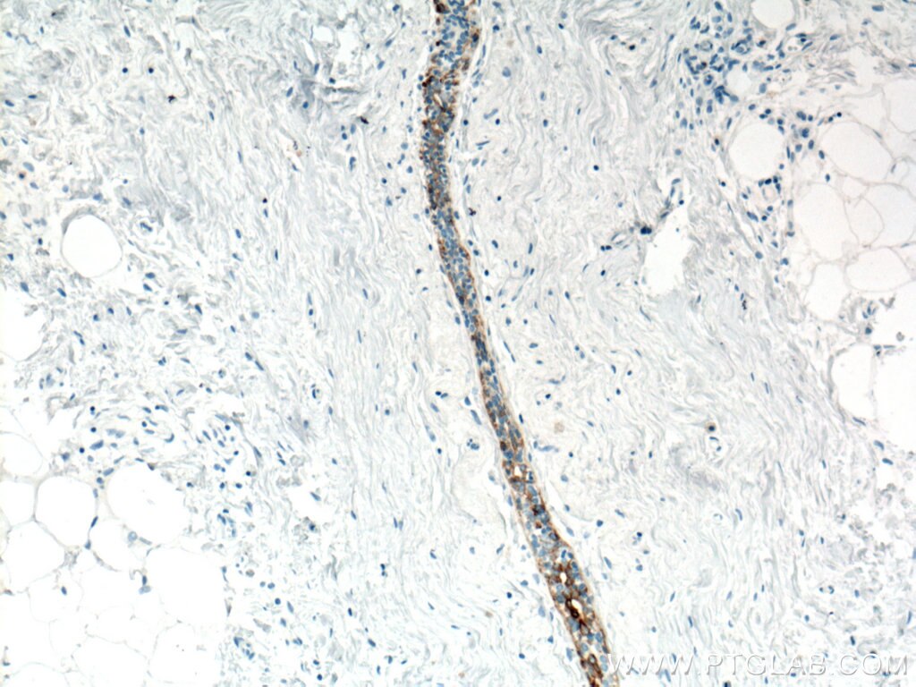 IHC staining of human breast hyperplasia using 66727-1-Ig