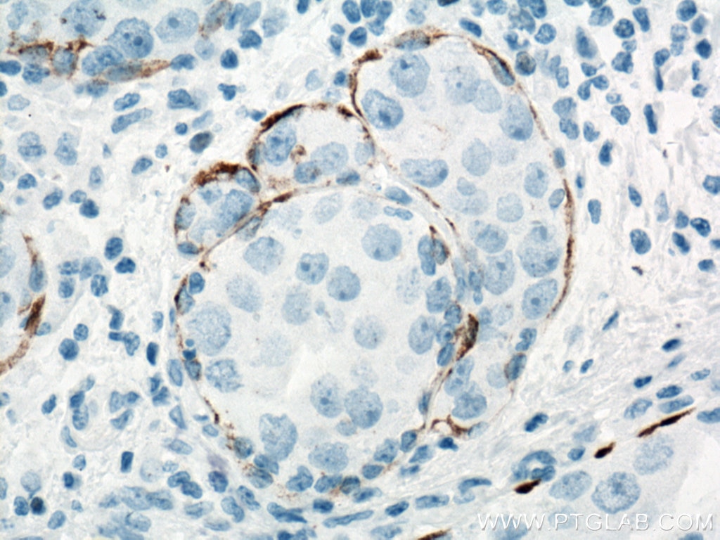 Immunohistochemistry (IHC) staining of human breast cancer tissue using Cytokeratin 5 Monoclonal antibody (66727-1-Ig)