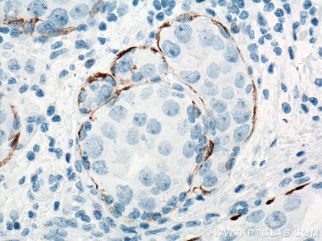 IHC staining of human breast cancer using 66727-1-Ig