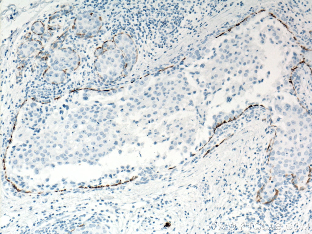 Immunohistochemistry (IHC) staining of human breast cancer tissue using Cytokeratin 5 Monoclonal antibody (66727-1-Ig)