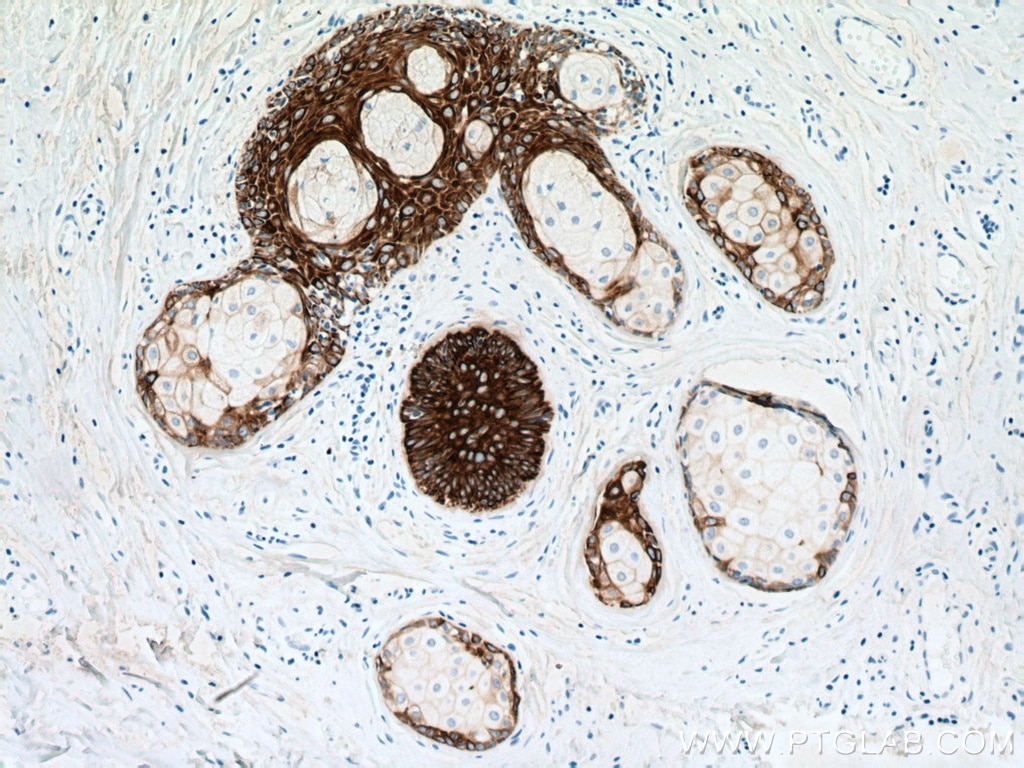 Immunohistochemistry (IHC) staining of human skin cancer tissue using Cytokeratin 5 Monoclonal antibody (66727-1-Ig)