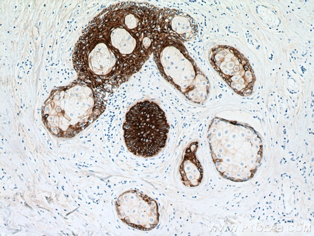 IHC staining of human skin cancer using 66727-1-Ig