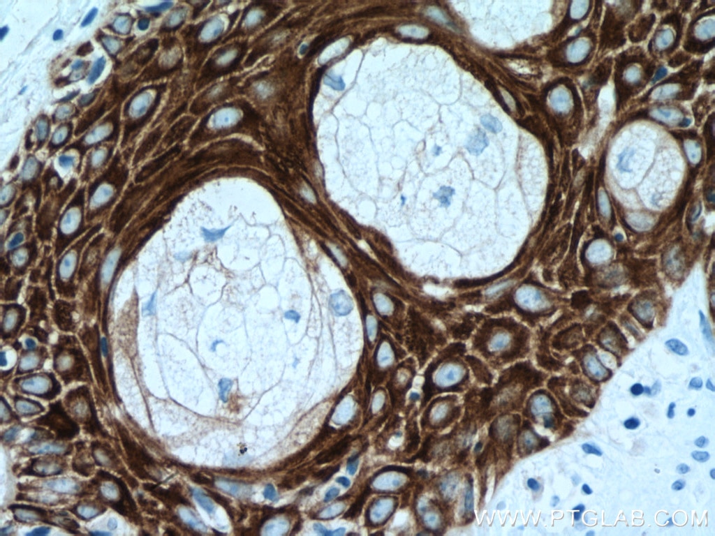 Immunohistochemistry (IHC) staining of human skin cancer tissue using Cytokeratin 5 Monoclonal antibody (66727-1-Ig)