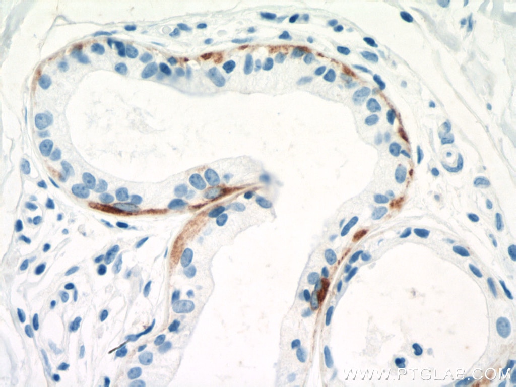 Immunohistochemistry (IHC) staining of human skin cancer tissue using Cytokeratin 5 Monoclonal antibody (66727-1-Ig)