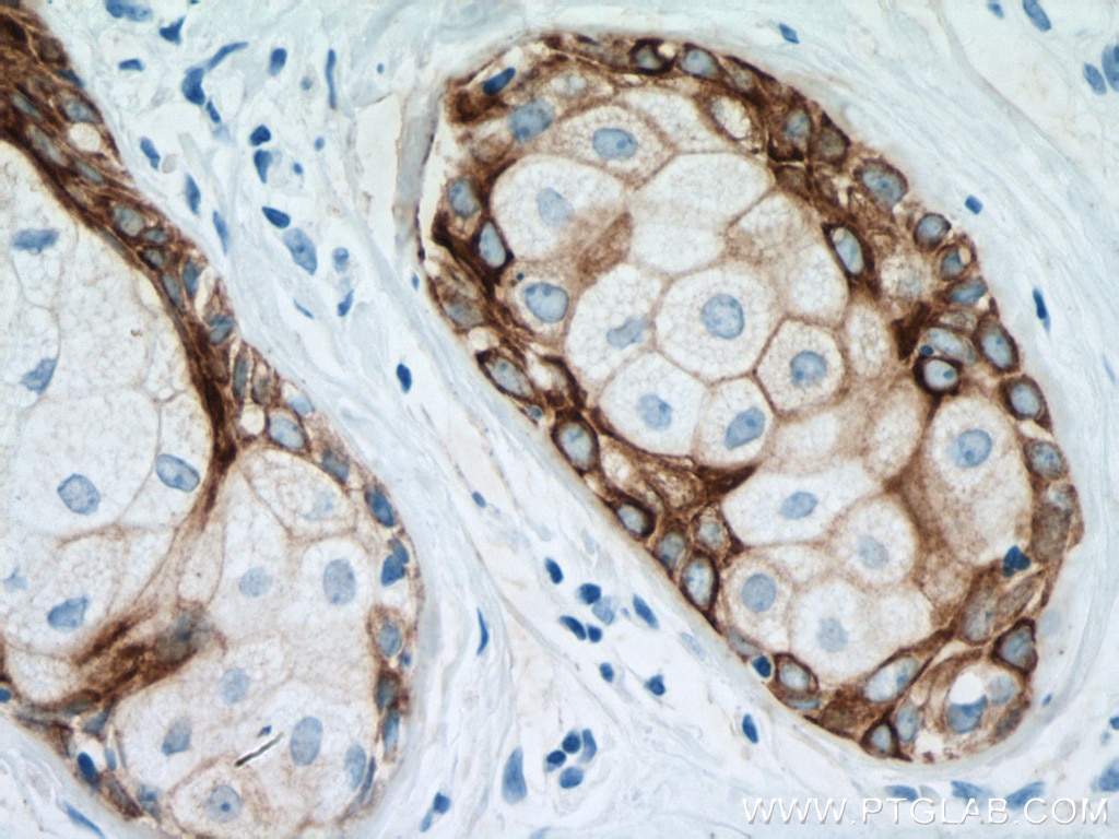 Immunohistochemistry (IHC) staining of human skin cancer tissue using Cytokeratin 5 Monoclonal antibody (66727-1-Ig)