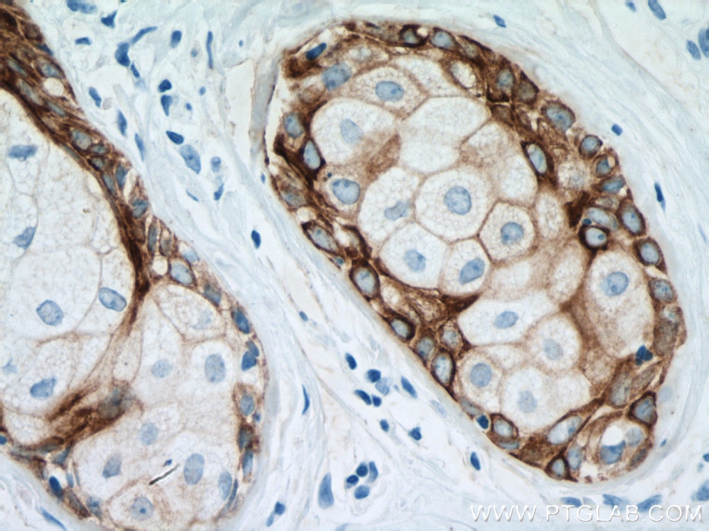 IHC staining of human skin cancer using 66727-1-Ig