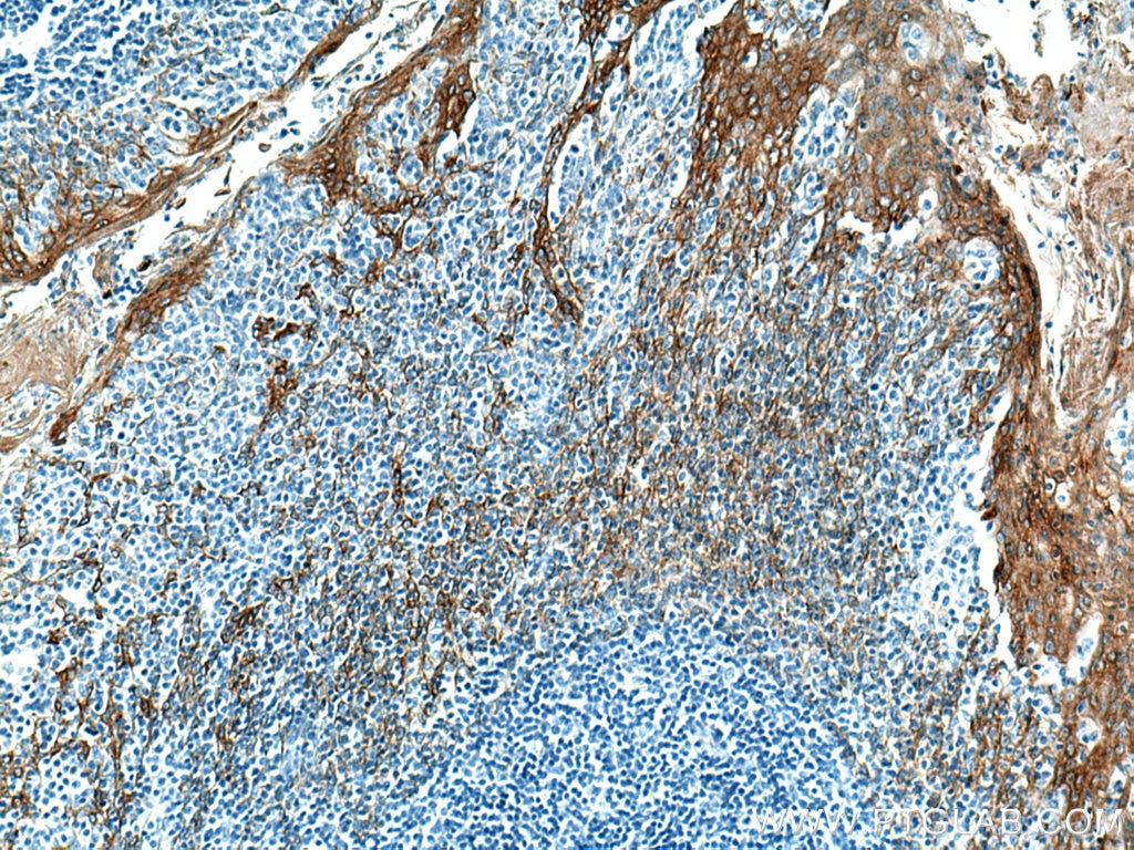 Immunohistochemistry (IHC) staining of human tonsillitis tissue using Cytokeratin 5 Monoclonal antibody (66727-1-Ig)