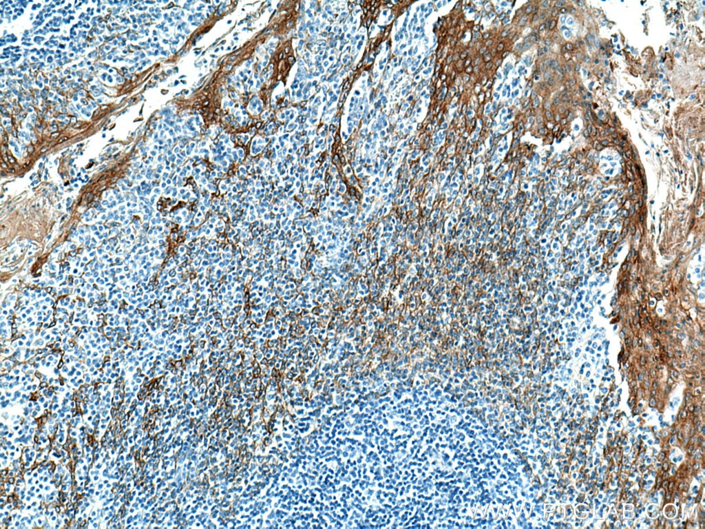 IHC staining of human tonsillitis using 66727-1-Ig