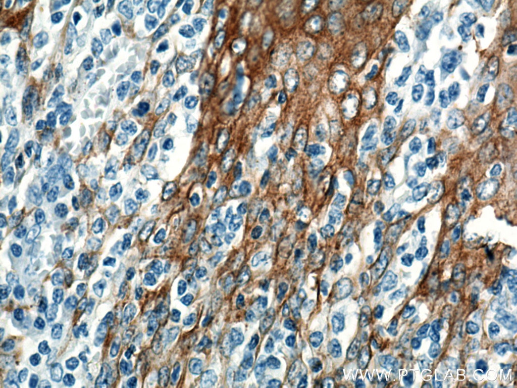 Immunohistochemistry (IHC) staining of human tonsillitis tissue using Cytokeratin 5 Monoclonal antibody (66727-1-Ig)