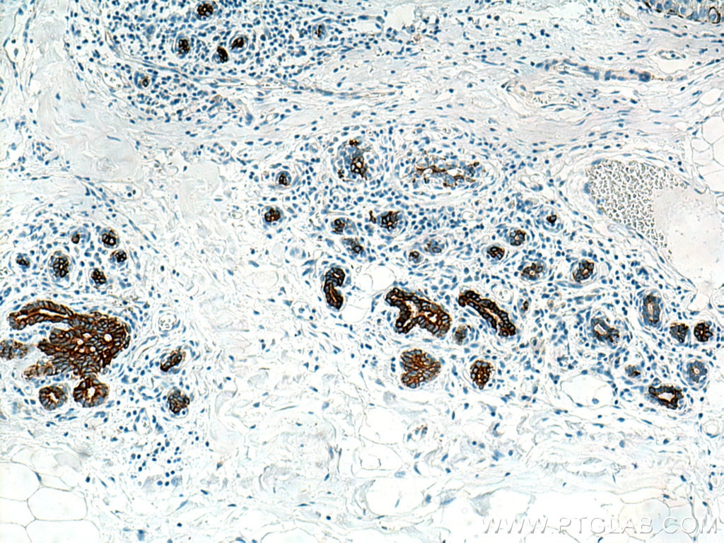 Immunohistochemistry (IHC) staining of human breast cancer tissue using Cytokeratin 5 Monoclonal antibody (66727-1-Ig)