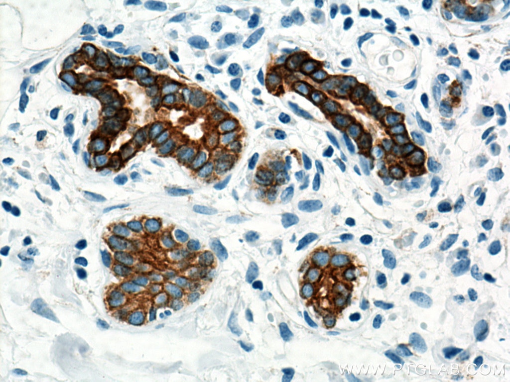 Immunohistochemistry (IHC) staining of human breast cancer tissue using Cytokeratin 5 Monoclonal antibody (66727-1-Ig)