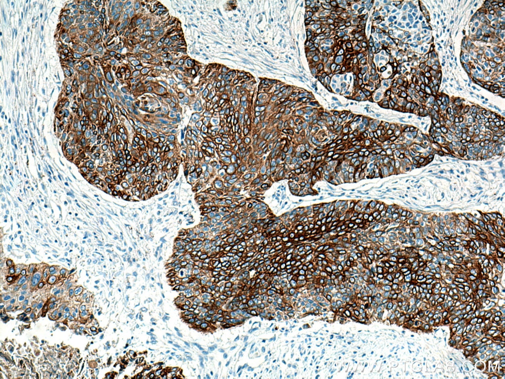 Immunohistochemistry (IHC) staining of human oesophagus cancer tissue using Cytokeratin 5 Monoclonal antibody (66727-1-Ig)