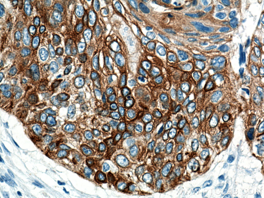Immunohistochemistry (IHC) staining of human oesophagus cancer tissue using Cytokeratin 5 Monoclonal antibody (66727-1-Ig)