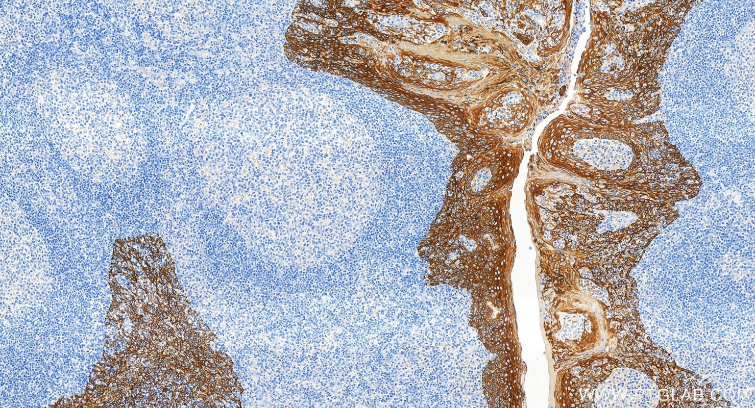Immunohistochemistry (IHC) staining of human tonsillitis tissue using Cytokeratin 5 Monoclonal antibody (66727-1-Ig)