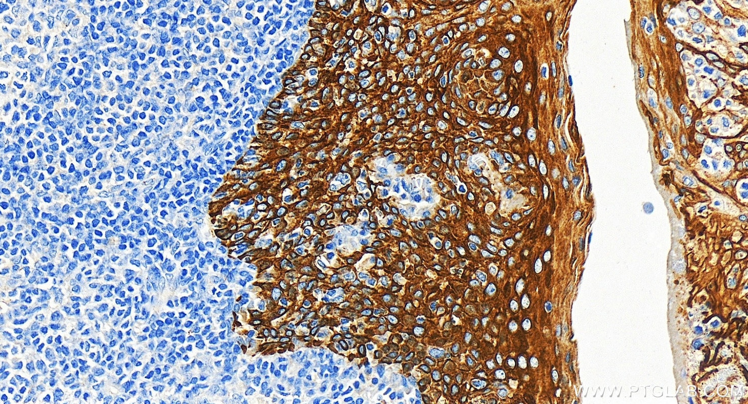 Immunohistochemistry (IHC) staining of human tonsillitis tissue using Cytokeratin 5 Monoclonal antibody (66727-1-Ig)
