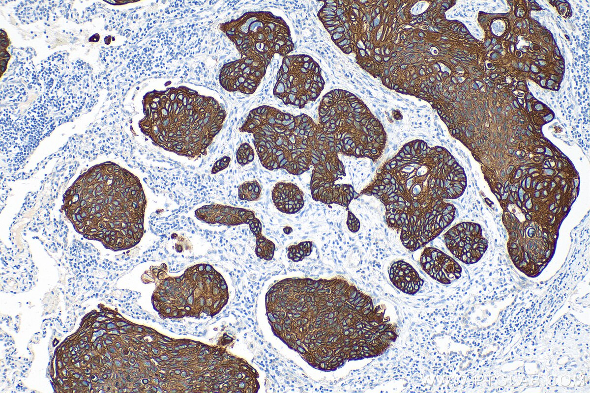 Immunohistochemistry (IHC) staining of human lung cancer tissue using Cytokeratin 5 Recombinant antibody (82548-7-RR)