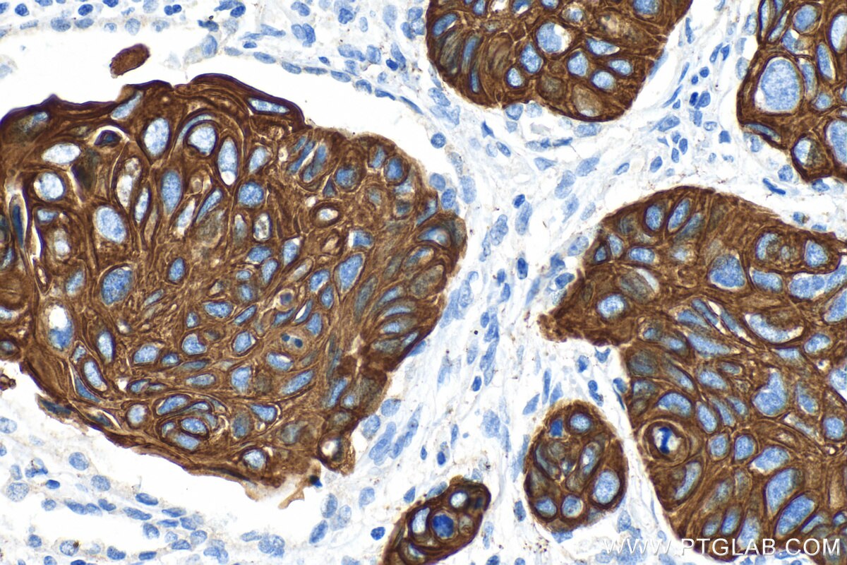 Immunohistochemistry (IHC) staining of human lung cancer tissue using Cytokeratin 5 Recombinant antibody (82548-7-RR)