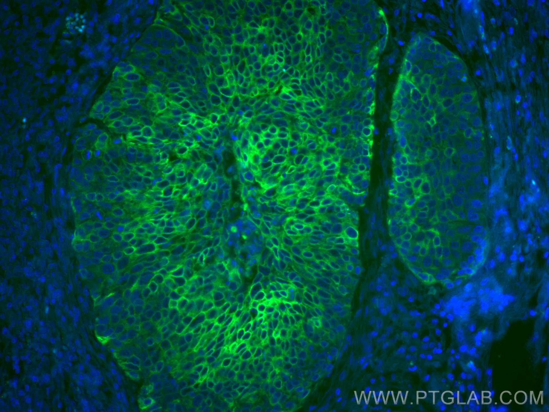 Immunofluorescence (IF) / fluorescent staining of human oesophagus cancer tissue using CoraLite® Plus 488-conjugated Cytokeratin 5 Monocl (CL488-66727)