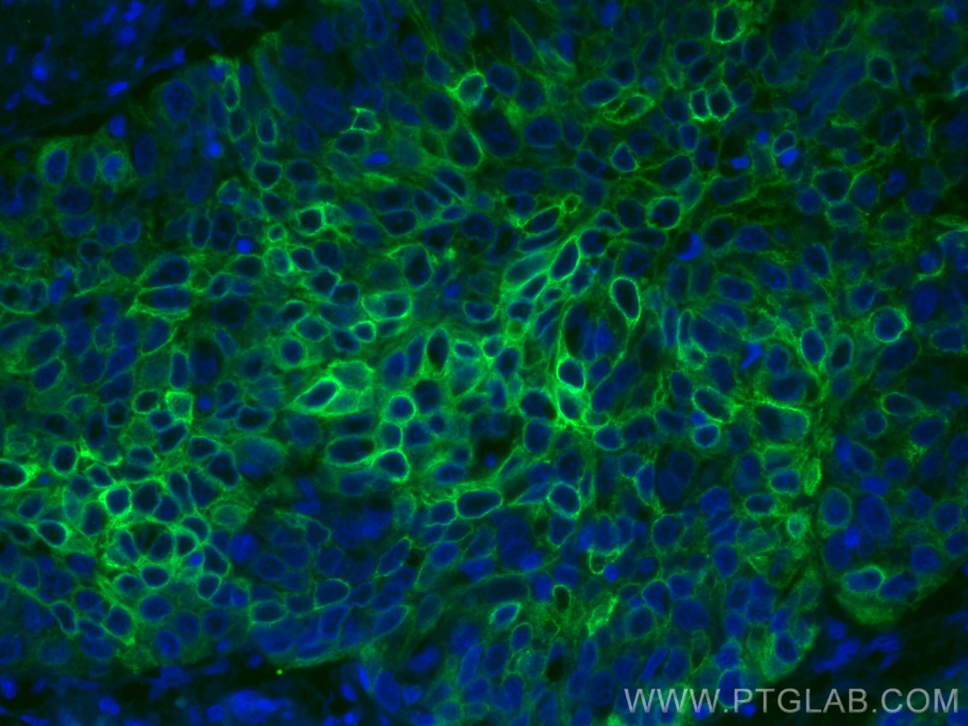 Immunofluorescence (IF) / fluorescent staining of human oesophagus cancer tissue using CoraLite® Plus 488-conjugated Cytokeratin 5 Monocl (CL488-66727)