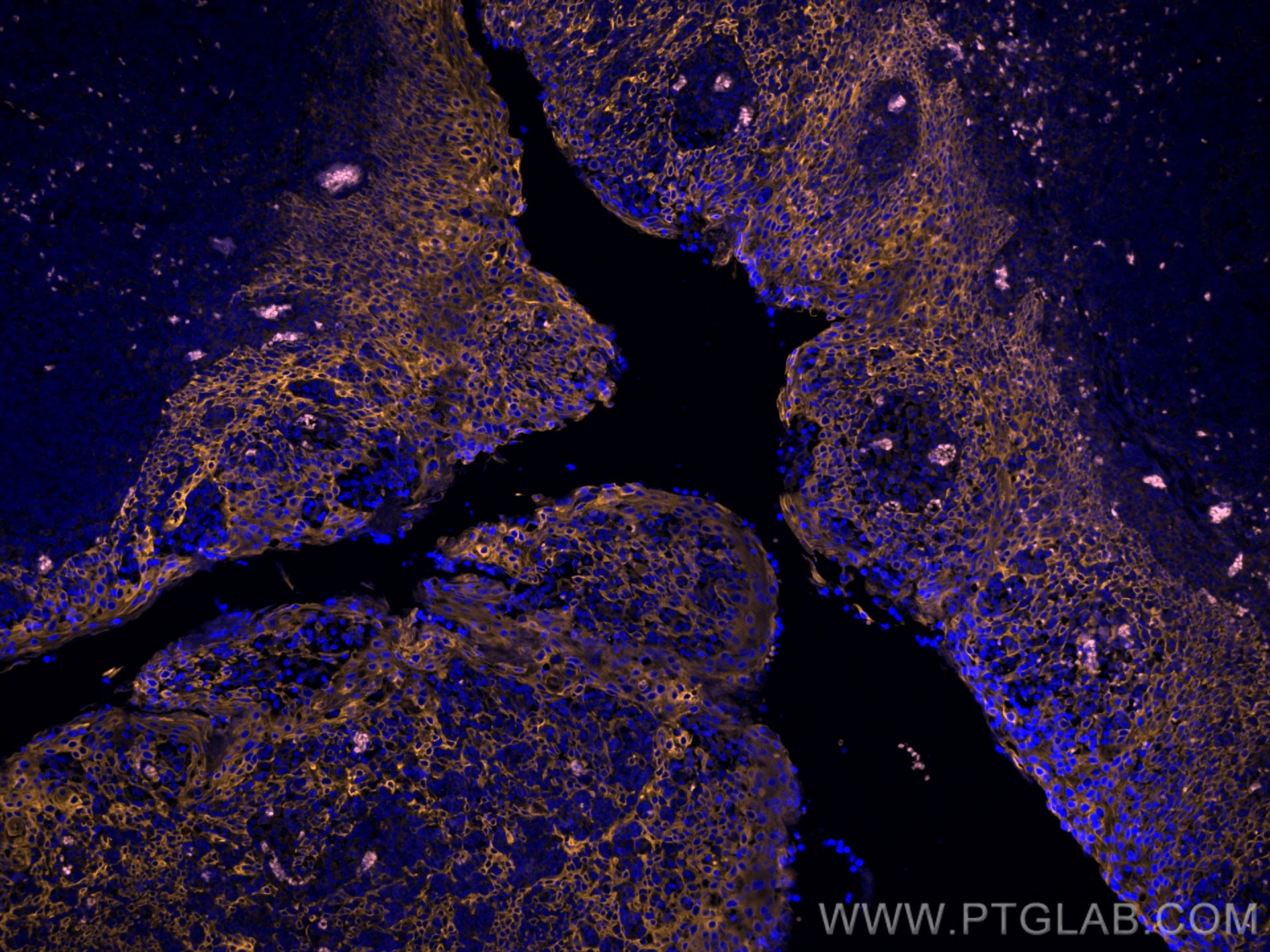 Immunofluorescence (IF) / fluorescent staining of human tonsillitis tissue using CoraLite®555-conjugated Cytokeratin 5 Polyclonal a (CL555-28506)