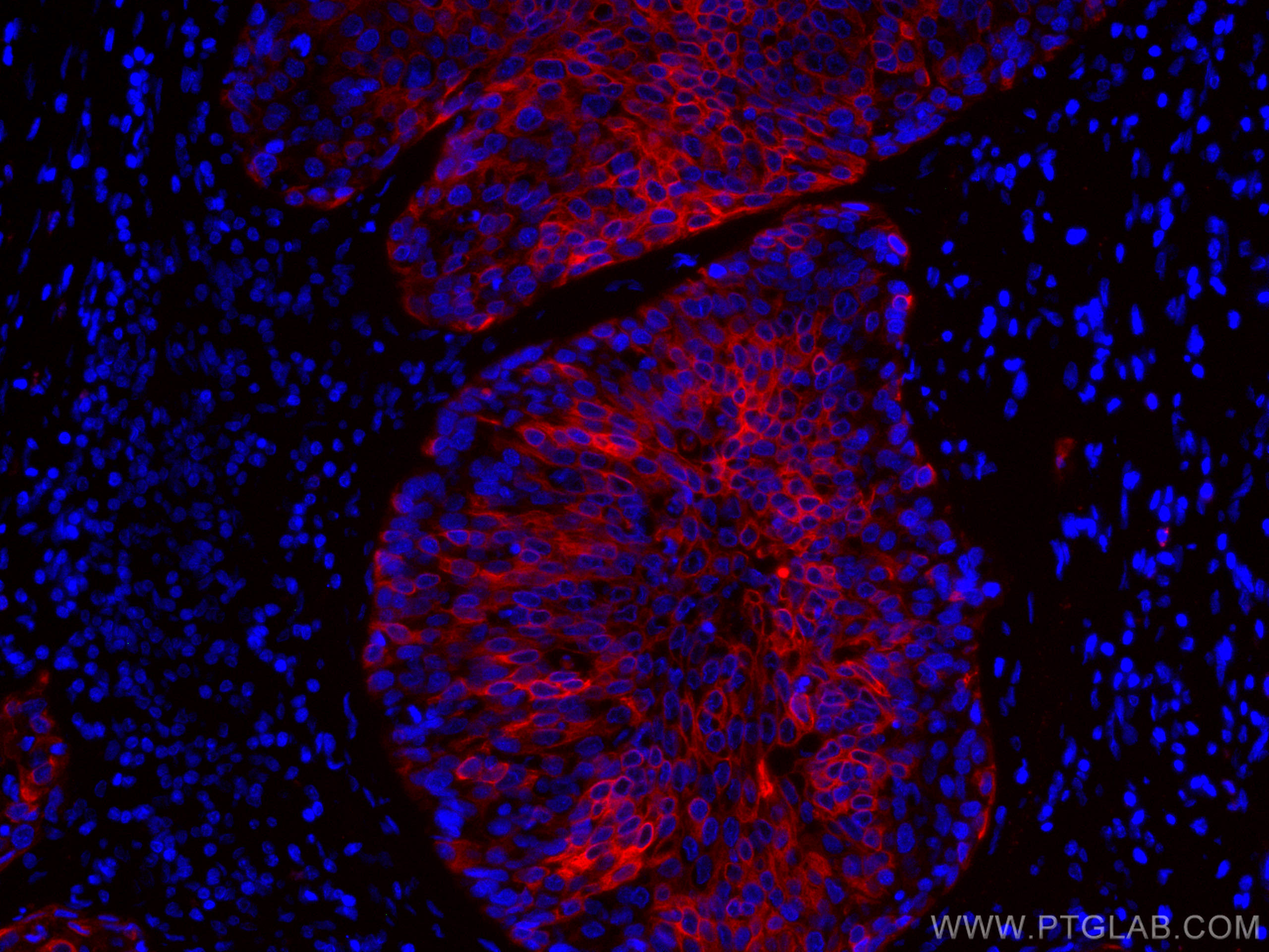 Immunofluorescence (IF) / fluorescent staining of human oesophagus cancer tissue using CoraLite®594-conjugated Cytokeratin 5 Monoclonal a (CL594-66727)