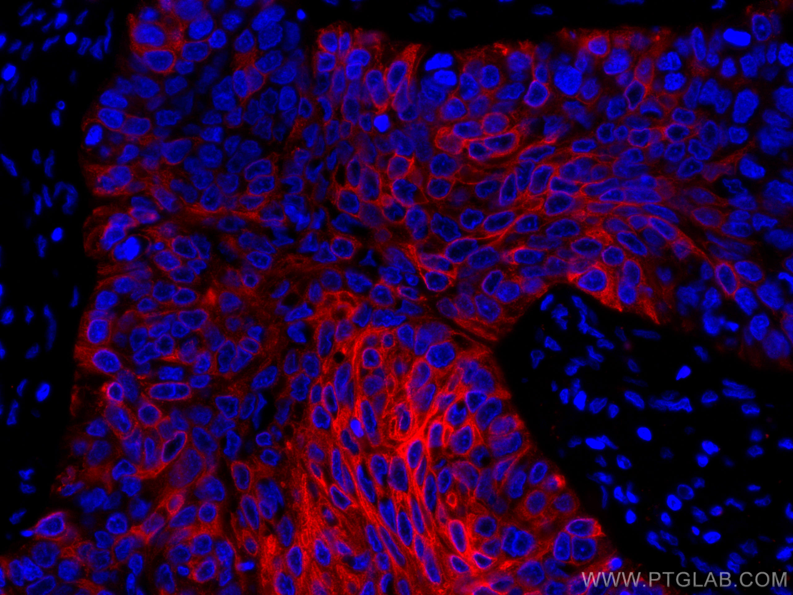Immunofluorescence (IF) / fluorescent staining of human oesophagus cancer tissue using CoraLite®594-conjugated Cytokeratin 5 Monoclonal a (CL594-66727)