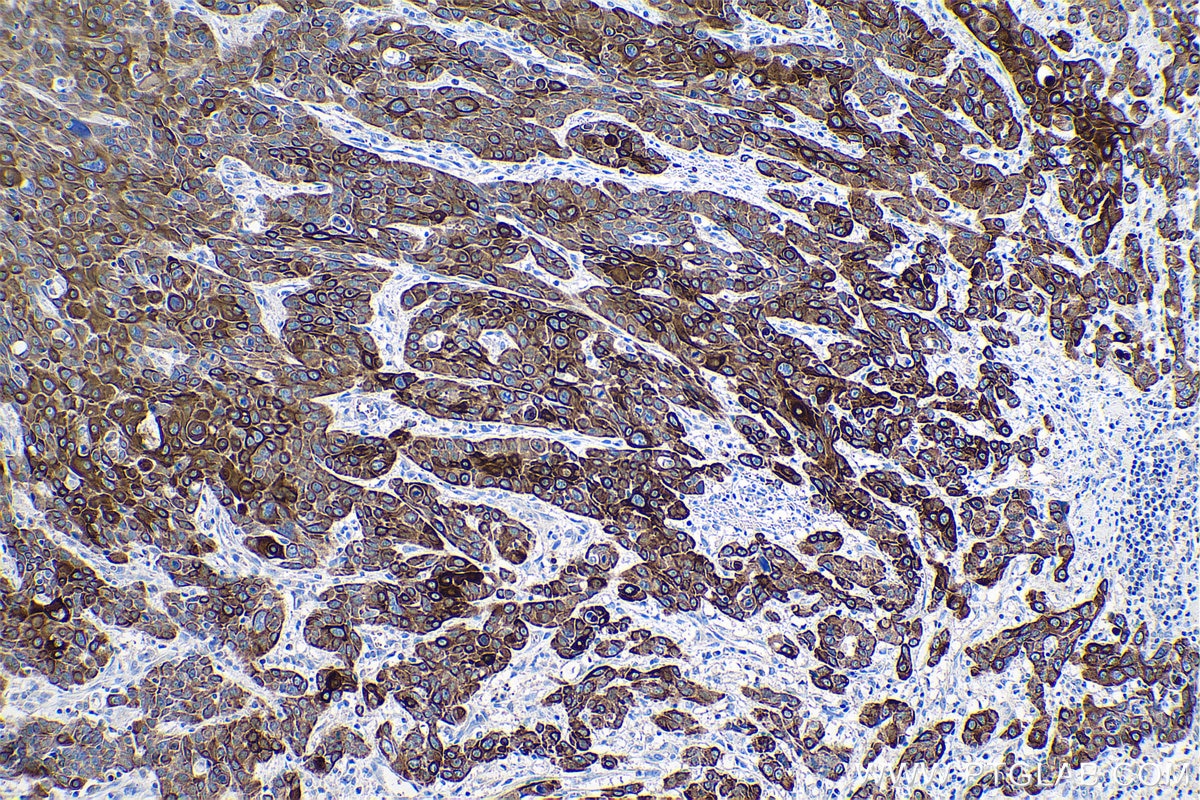 Immunohistochemistry (IHC) staining of human oesophagus cancer tissue using Cytokeratin 6 Monoclonal antibody (68294-1-Ig)