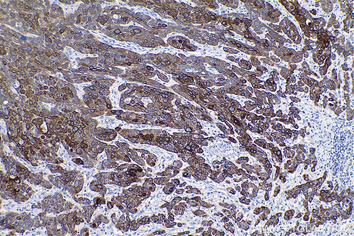 IHC staining of human oesophagus cancer using 68294-1-Ig