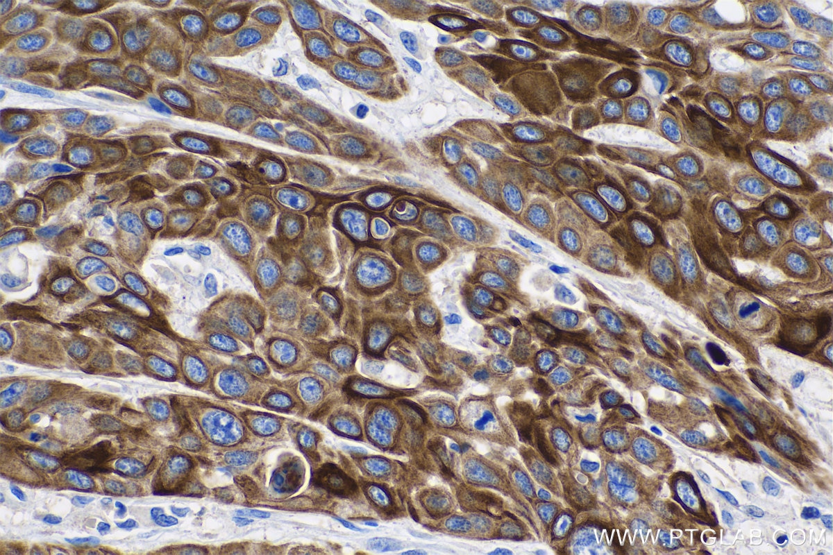 Immunohistochemistry (IHC) staining of human oesophagus cancer tissue using Cytokeratin 6 Monoclonal antibody (68294-1-Ig)