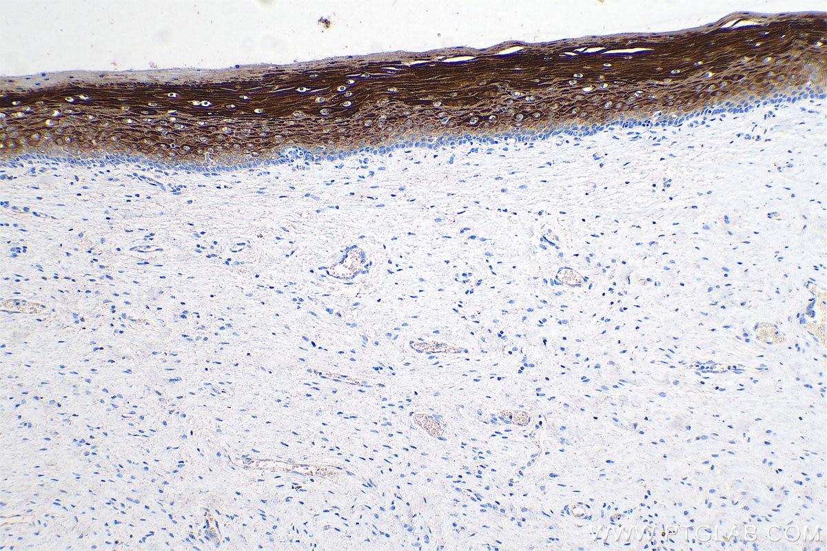 Immunohistochemistry (IHC) staining of human cervical cancer tissue using Cytokeratin 6 Monoclonal antibody (68294-1-Ig)