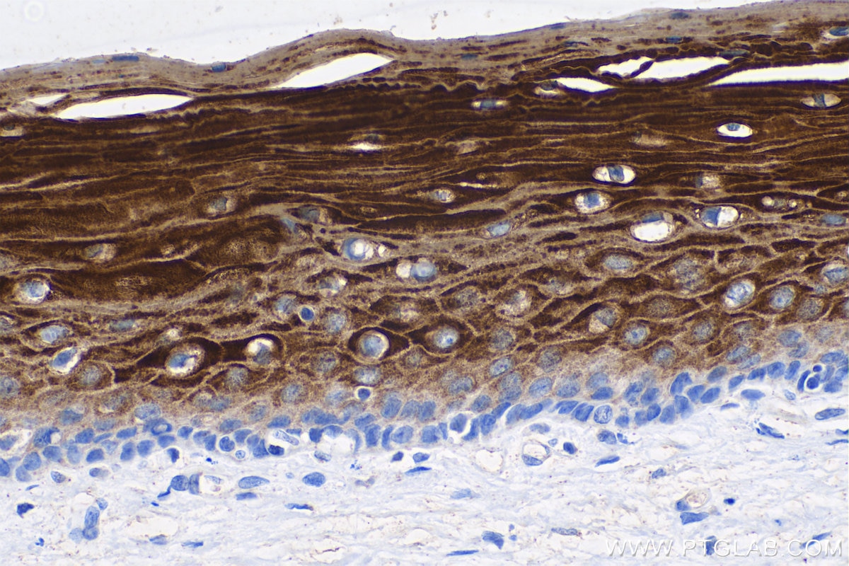 Immunohistochemistry (IHC) staining of human cervical cancer tissue using Cytokeratin 6 Monoclonal antibody (68294-1-Ig)