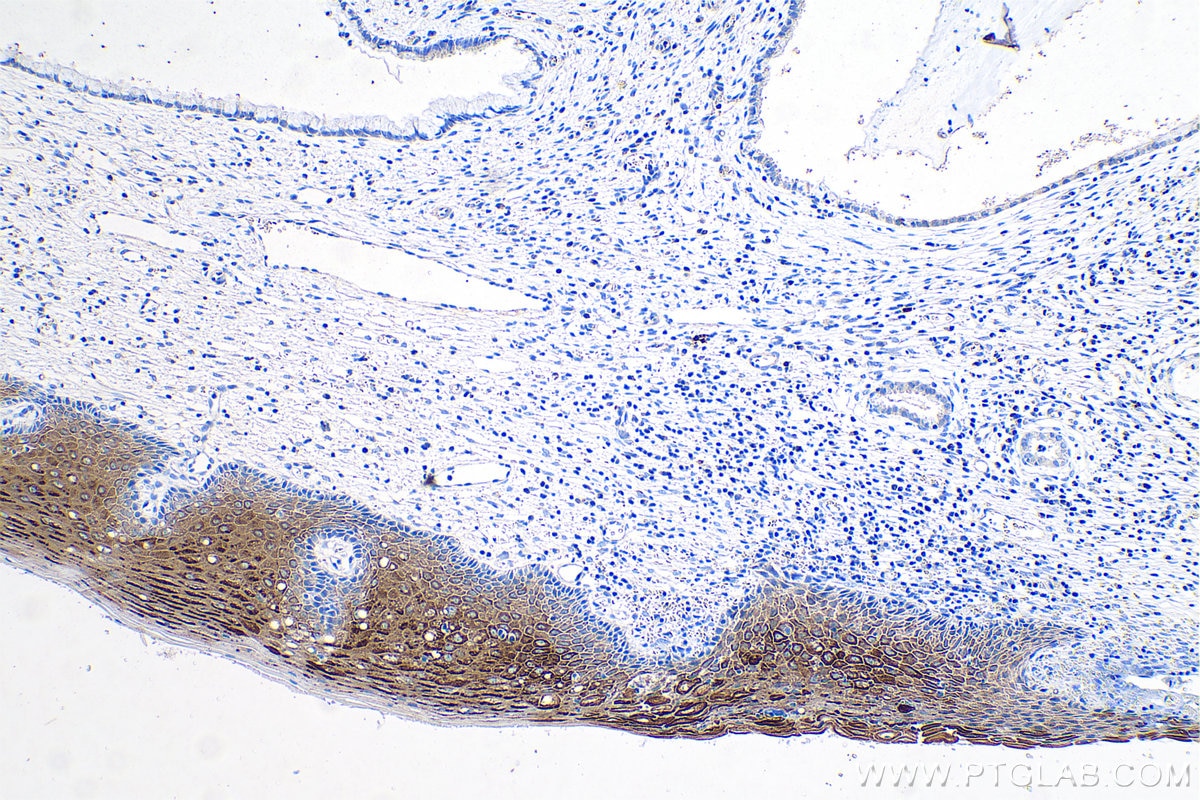 Immunohistochemistry (IHC) staining of human cervical cancer tissue using Cytokeratin 6 Monoclonal antibody (68294-1-Ig)