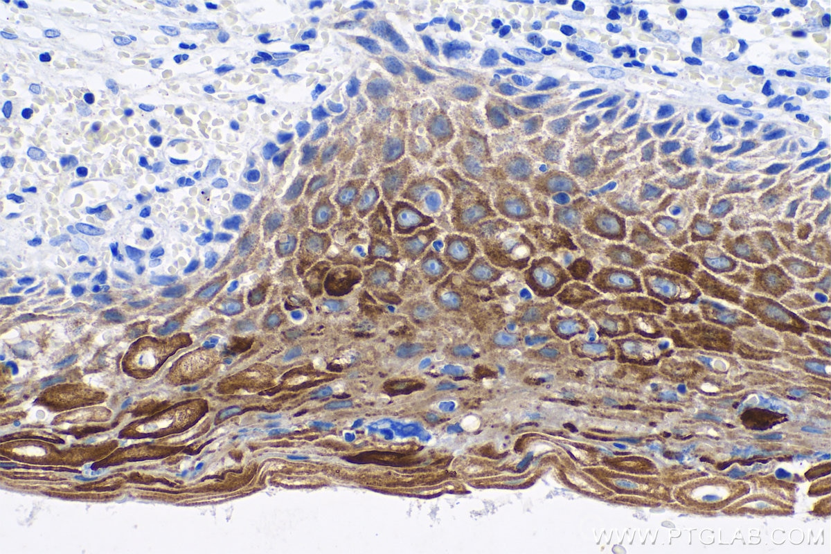 Immunohistochemistry (IHC) staining of human cervical cancer tissue using Cytokeratin 6 Monoclonal antibody (68294-1-Ig)