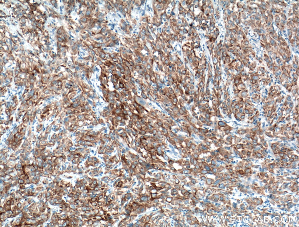 Immunohistochemistry (IHC) staining of human cervical cancer tissue using Cytokeratin 6A Monoclonal antibody (66685-1-Ig)