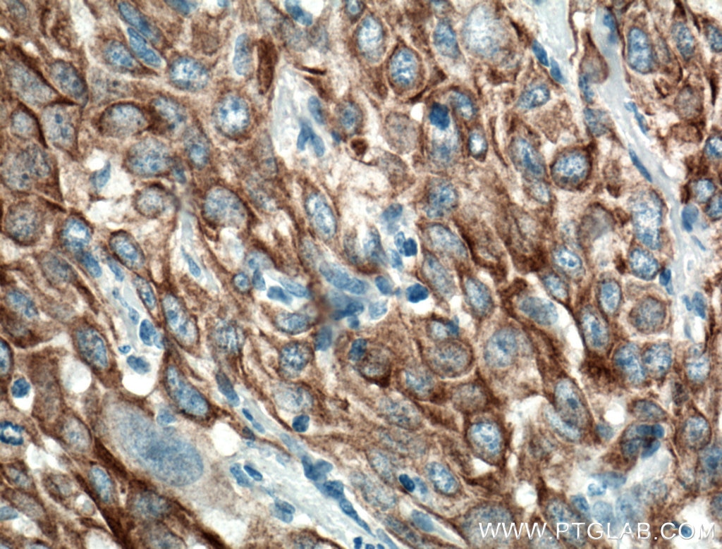 Immunohistochemistry (IHC) staining of human cervical cancer tissue using Cytokeratin 6A Monoclonal antibody (66685-1-Ig)