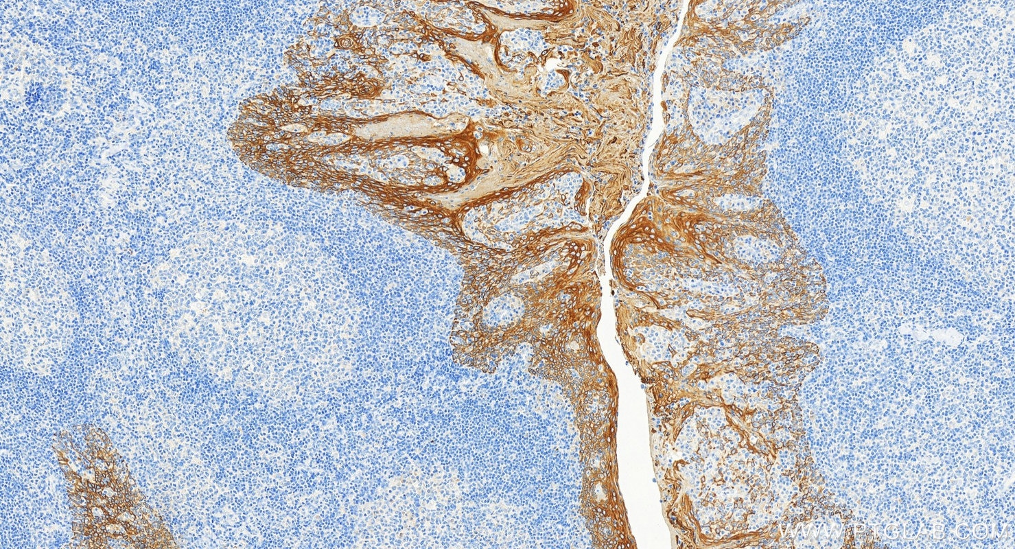 Immunohistochemistry (IHC) staining of human tonsillitis tissue using Cytokeratin 6A Monoclonal antibody (66685-1-Ig)