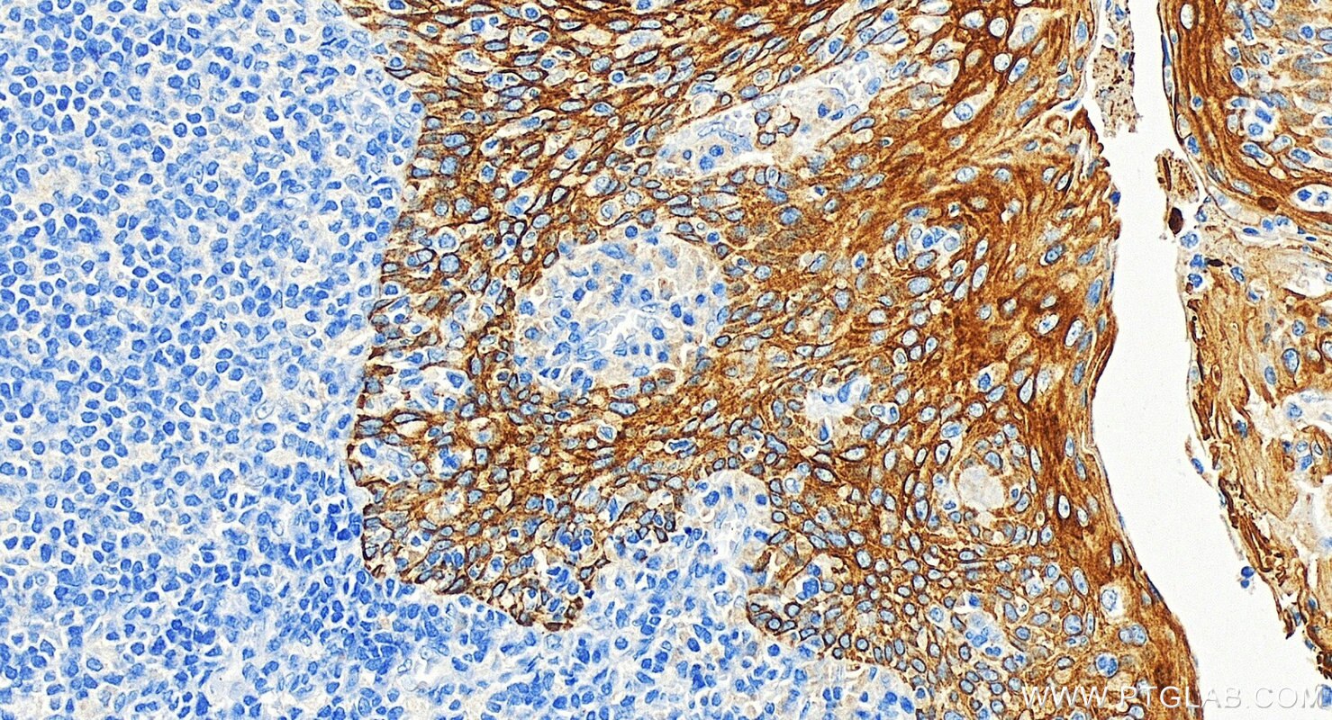 Immunohistochemistry (IHC) staining of human tonsillitis tissue using Cytokeratin 6A Monoclonal antibody (66685-1-Ig)
