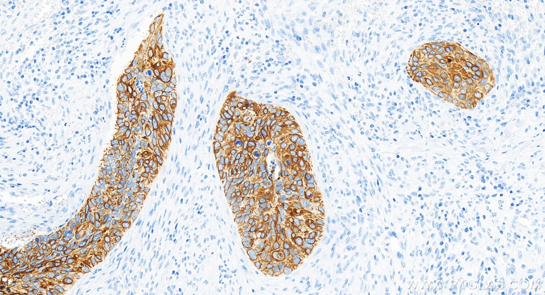 Immunohistochemistry (IHC) staining of human cervical cancer tissue using Cytokeratin 6B Recombinant antibody (85423-2-RR)