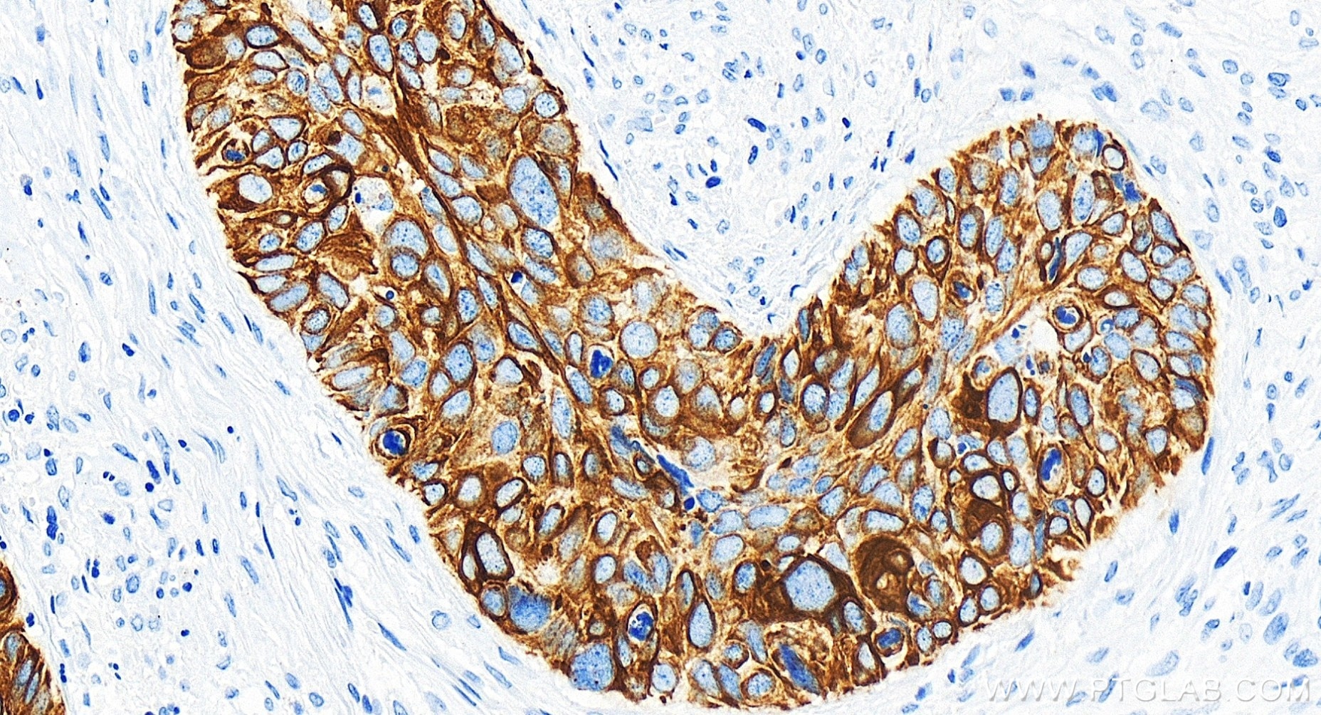 Immunohistochemistry (IHC) staining of human cervical cancer tissue using Cytokeratin 6B Recombinant antibody (85423-2-RR)