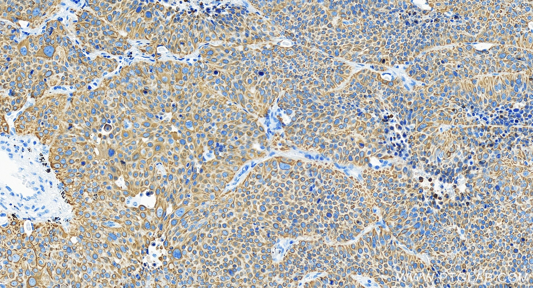 Immunohistochemistry (IHC) staining of human lung cancer tissue using Cytokeratin 6B Recombinant antibody (85423-2-RR)
