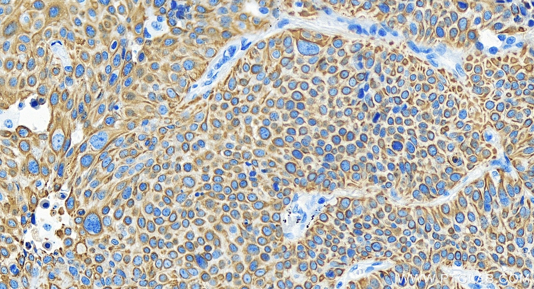 Immunohistochemistry (IHC) staining of human lung cancer tissue using Cytokeratin 6B Recombinant antibody (85423-2-RR)
