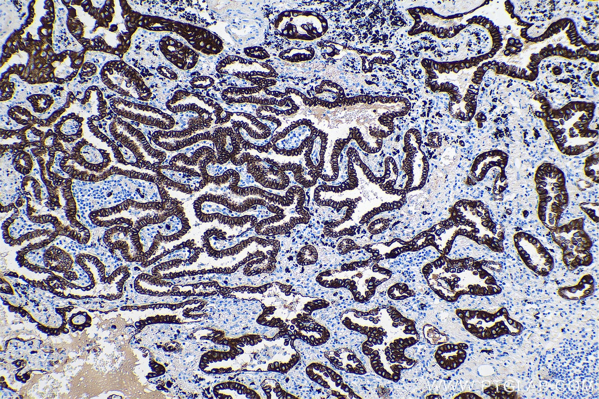 Immunohistochemistry (IHC) staining of human lung cancer tissue using Cytokeratin 7 Monoclonal antibody (68296-1-Ig)
