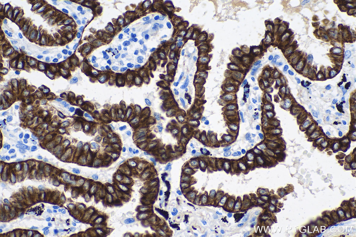 Immunohistochemistry (IHC) staining of human lung cancer tissue using Cytokeratin 7 Monoclonal antibody (68296-1-Ig)