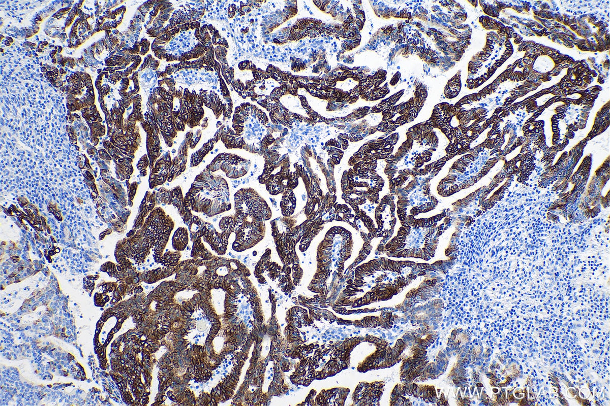 Immunohistochemistry (IHC) staining of human endometrial cancer tissue using Cytokeratin 7 Monoclonal antibody (68296-1-Ig)