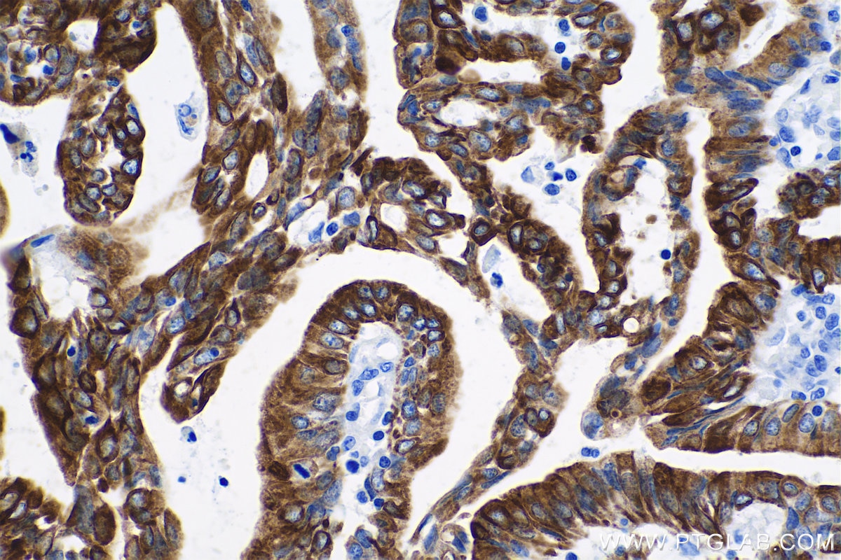 Immunohistochemistry (IHC) staining of human endometrial cancer tissue using Cytokeratin 7 Monoclonal antibody (68296-1-Ig)