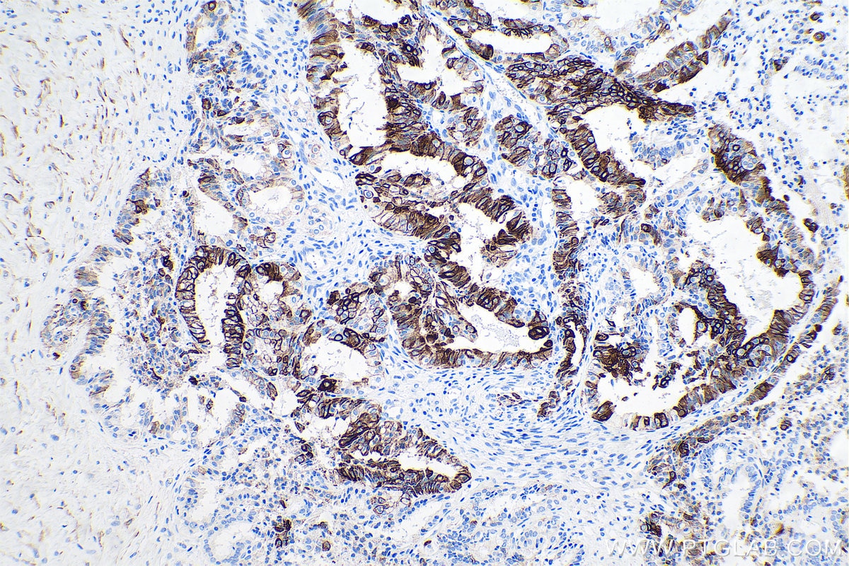 Immunohistochemistry (IHC) staining of human ovary tumor tissue using Cytokeratin 7 Monoclonal antibody (68296-1-Ig)