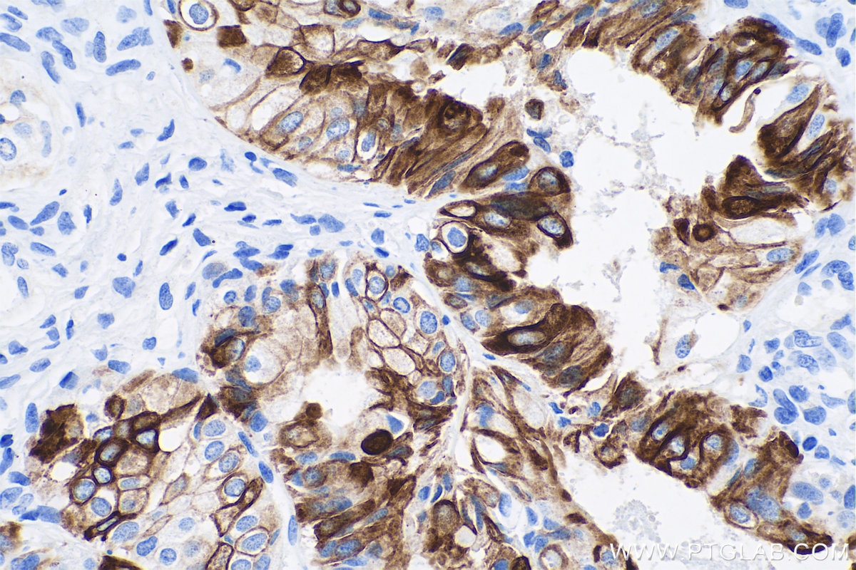 Immunohistochemistry (IHC) staining of human ovary tumor tissue using Cytokeratin 7 Monoclonal antibody (68296-1-Ig)