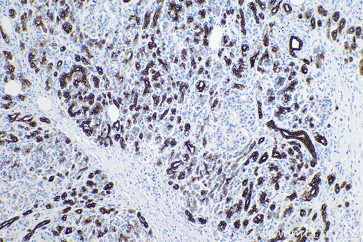 Immunohistochemistry (IHC) staining of human pancreas cancer tissue using Cytokeratin 7 Monoclonal antibody (68296-1-Ig)