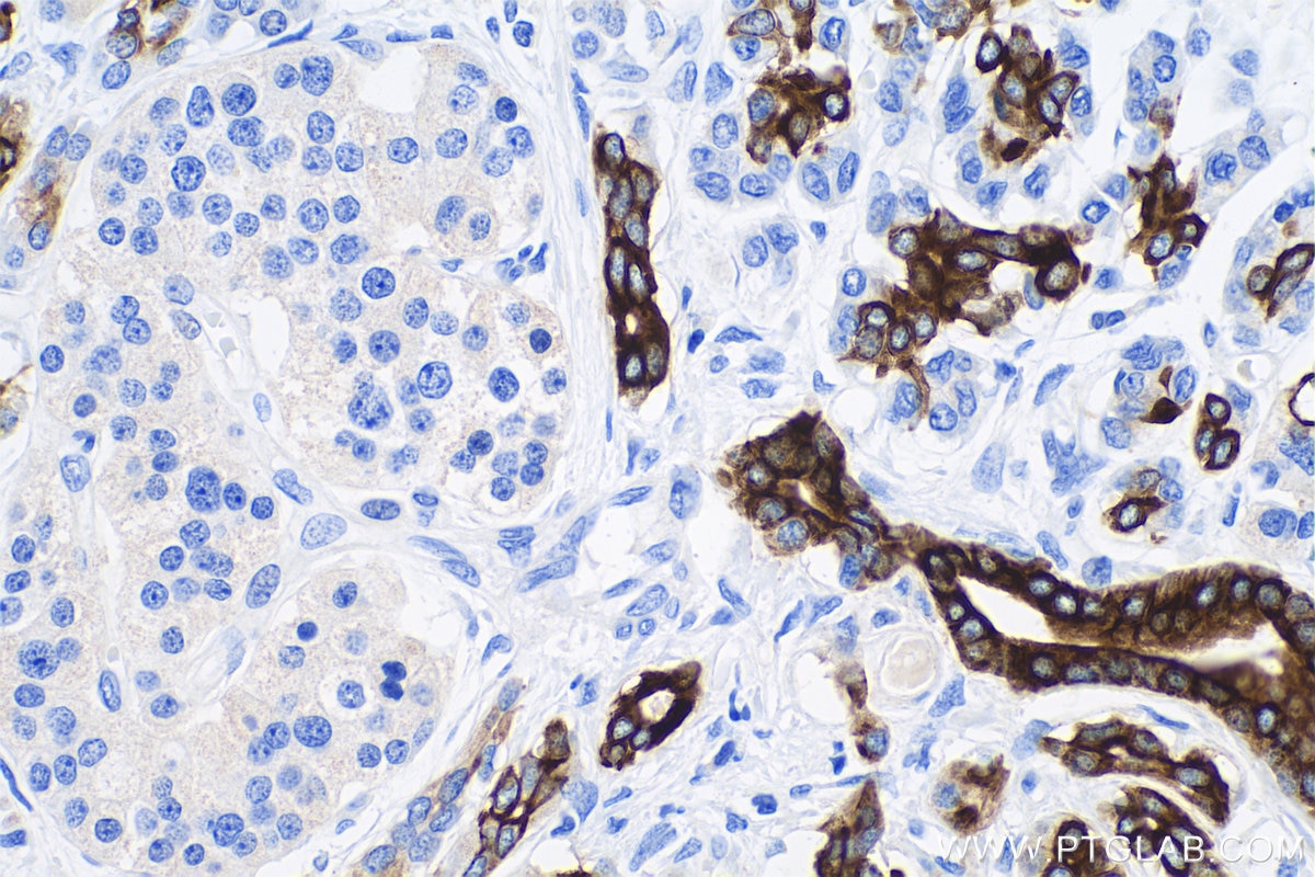 Immunohistochemistry (IHC) staining of human pancreas cancer tissue using Cytokeratin 7 Monoclonal antibody (68296-1-Ig)